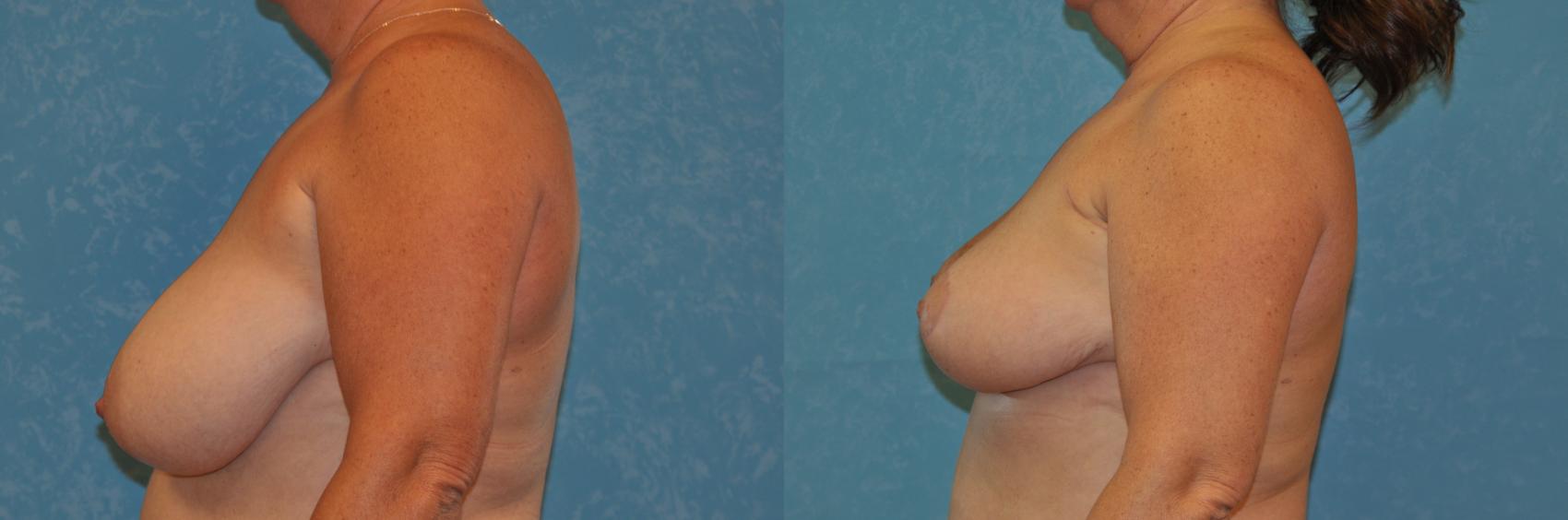 Before & After Breast Reduction Case 399 Left Side View in Toledo, Ohio