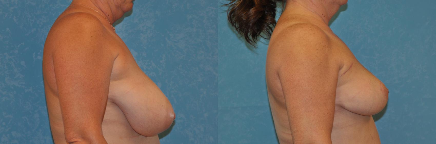 Before & After Breast Reduction Case 399 Right Side View in Toledo, Ohio