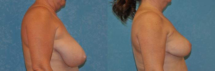 Before & After Breast Reduction Case 399 Right Side View in Toledo, Ohio