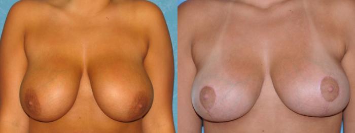 Before & After Breast Reduction Case 40 View #1 View in Toledo, Ohio