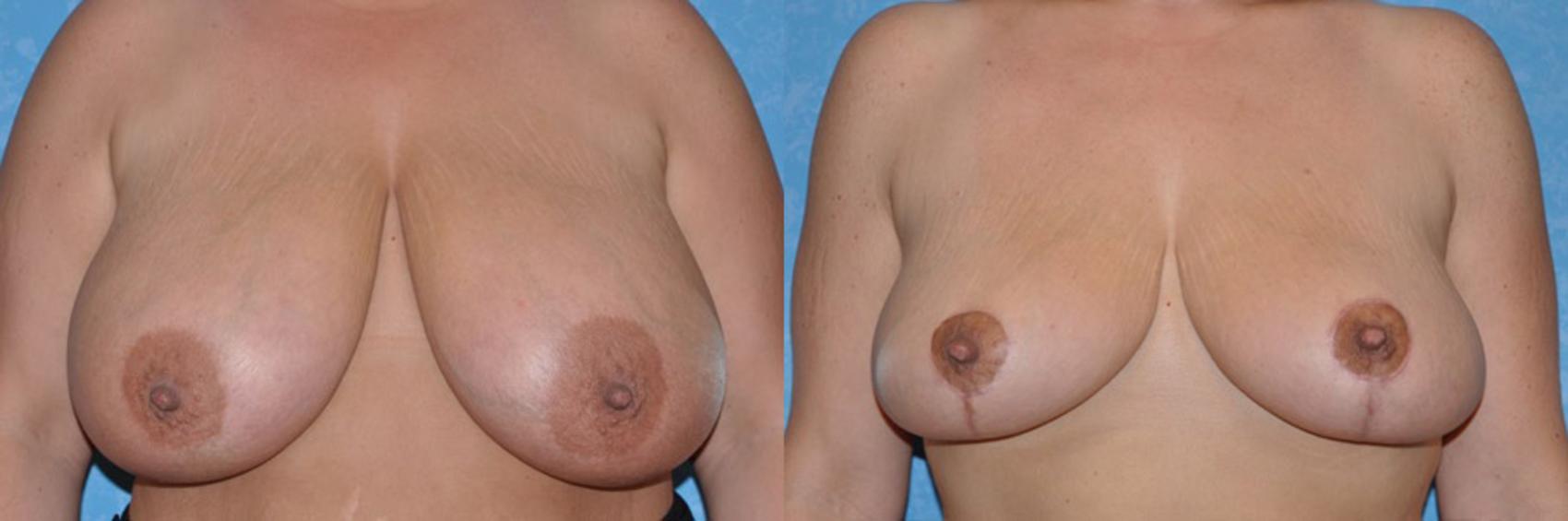 Before & After Breast Reduction Case 41 View #1 View in Toledo, Ohio