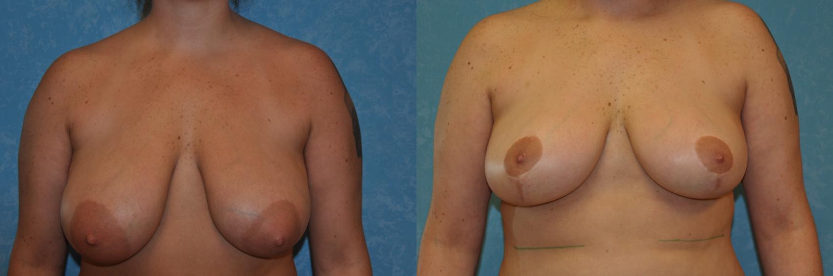 Before & After Breast Reduction Case 415 Front View in Toledo, Ohio