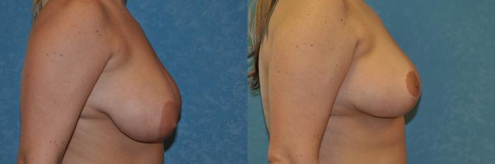 Before & After Breast Reduction Case 415 Right Side View in Toledo, Ohio