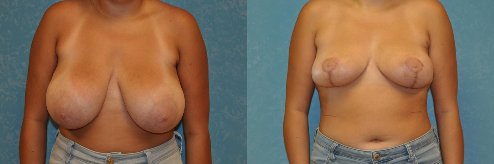 Before & After Breast Reduction Case 420 Front View in Toledo, Ohio