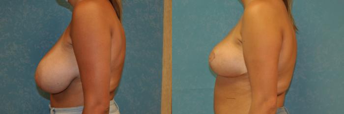 Before & After Breast Reduction Case 420 Left Side View in Toledo, Ohio