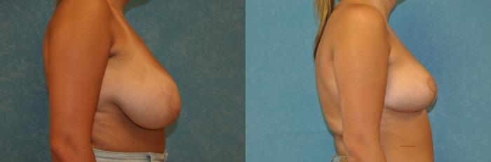 Before & After Breast Reduction Case 420 Right Side View in Toledo, Ohio