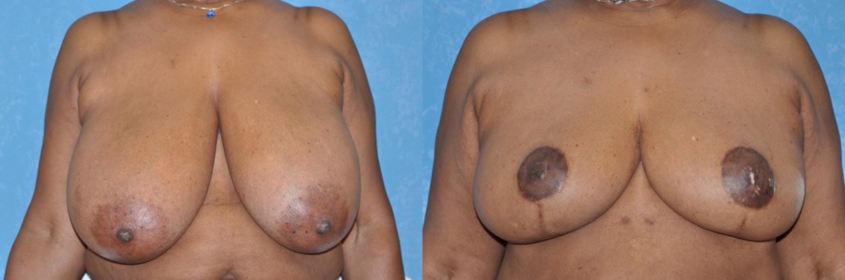 Before & After Breast Reduction Case 43 View #1 View in Toledo, Ohio