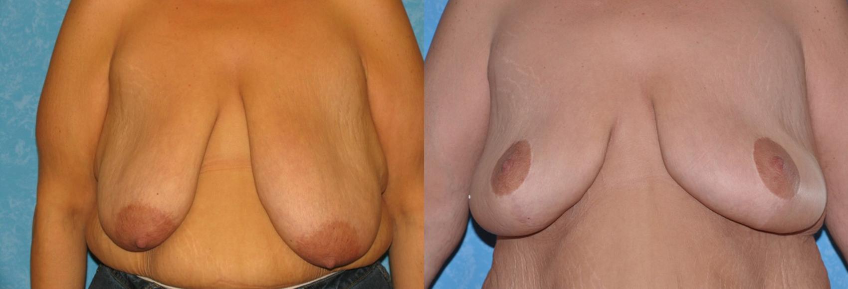 Before & After Breast Reduction Case 44 View #1 View in Toledo, Ohio