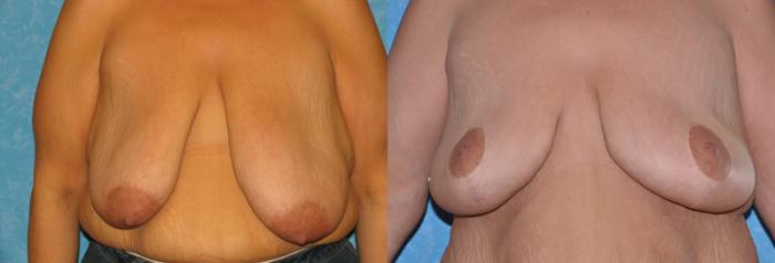 Before & After Breast Reduction Case 44 View #1 View in Toledo, Ohio