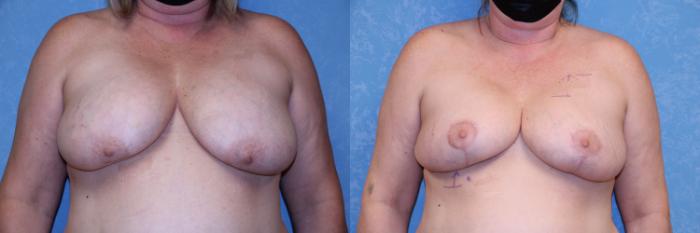 Before & After Breast Augmentation Case 454 Front View in Toledo, Ohio