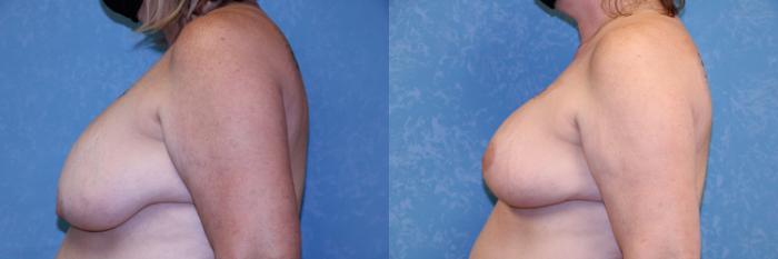 Before & After Breast Augmentation Case 454 Left Side View in Toledo, Ohio