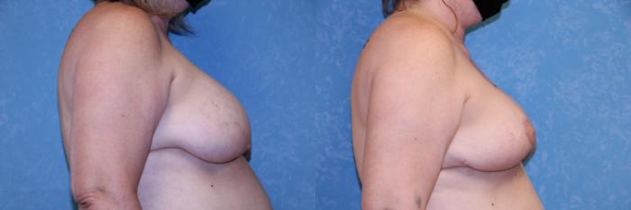 Before & After Breast Reduction Case 454 Right Side View in Toledo, Ohio