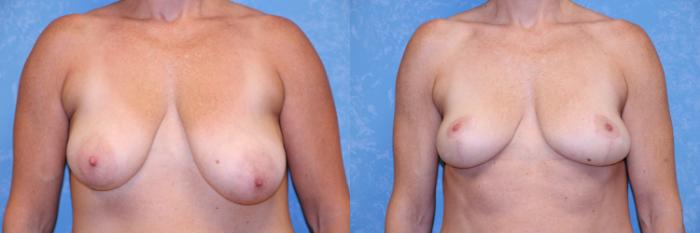 Before & After Breast Reduction Case 456 Front View in Toledo, Ohio