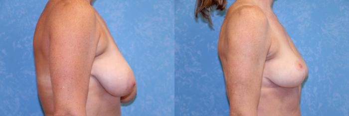 Before & After Breast Reduction Case 456 Right Side View in Toledo, Ohio