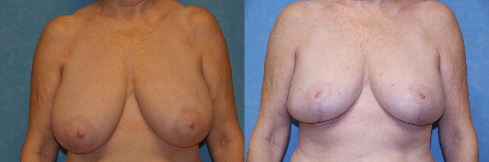 Before & After Breast Reduction Case 458 Front View in Toledo, Ohio