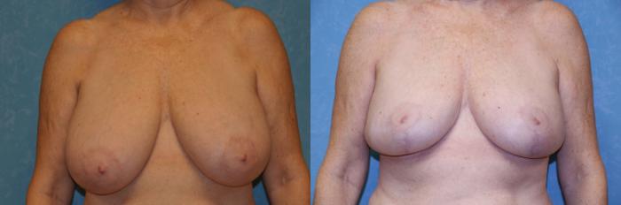 Before & After Breast Reduction Case 458 Front View in Toledo, Ohio