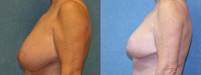 Before & After Breast Reduction Case 458 Left Side View in Toledo, Ohio
