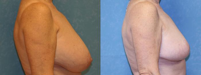 Before & After Breast Reduction Case 458 Right Side View in Toledo, Ohio