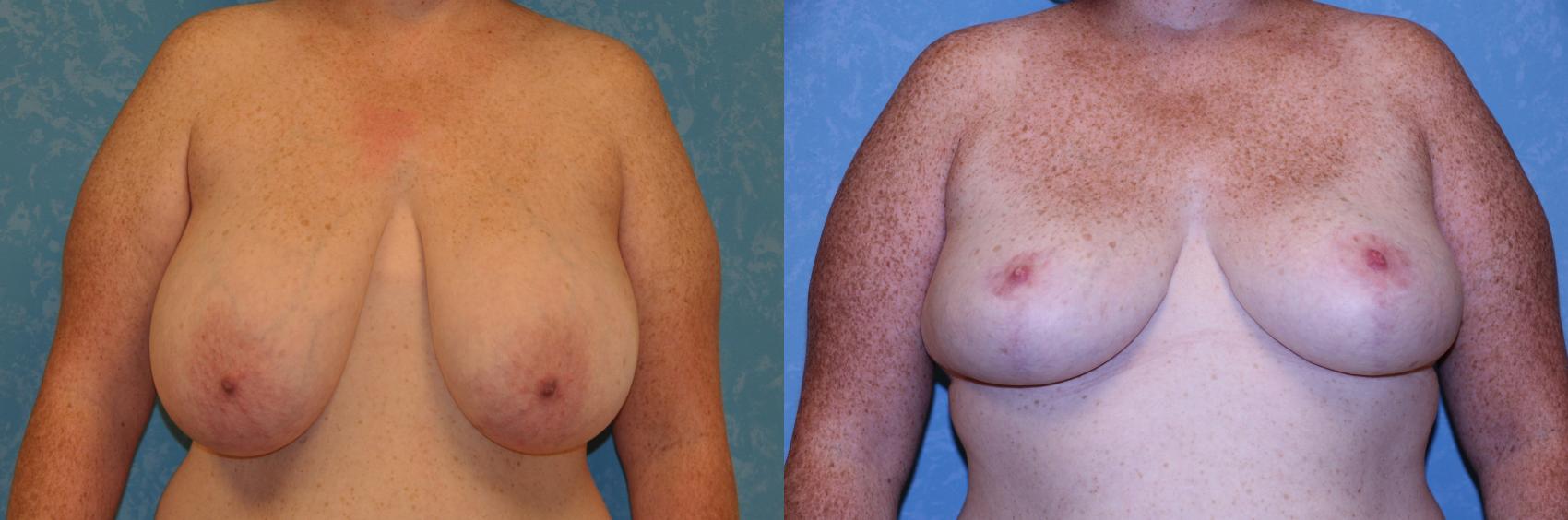 Before & After Breast Reduction Case 464 Front View in Toledo, Ohio