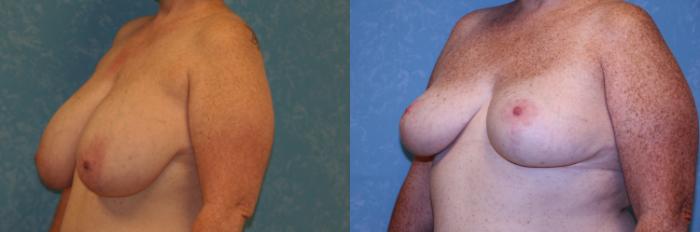 Before & After Breast Reduction Case 464 Left Oblique View in Toledo, Ohio