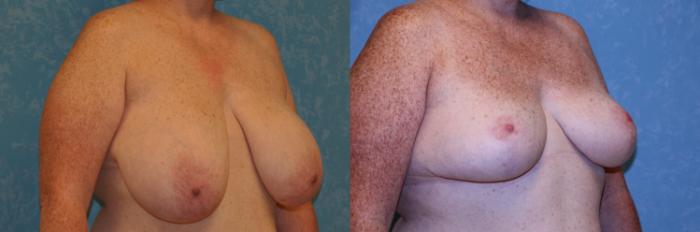 Before & After Breast Reduction Case 464 Right Oblique View in Toledo, Ohio