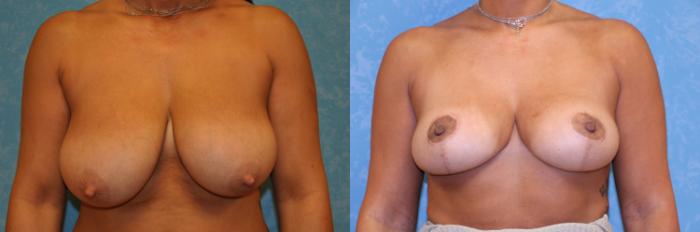 Before & After Breast Reduction Case 465 Front View in Toledo, Ohio