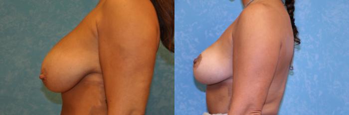 Before & After Breast Reduction Case 465 Left Side View in Toledo, Ohio