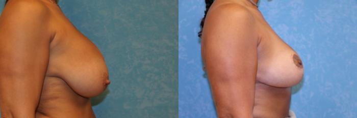 Before & After Breast Reduction Case 465 Right Side View in Toledo, Ohio