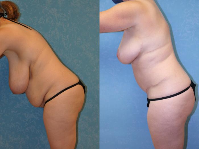Before & After Mommy Makeover Case 468 Bent Forward Left View in Toledo, Ohio