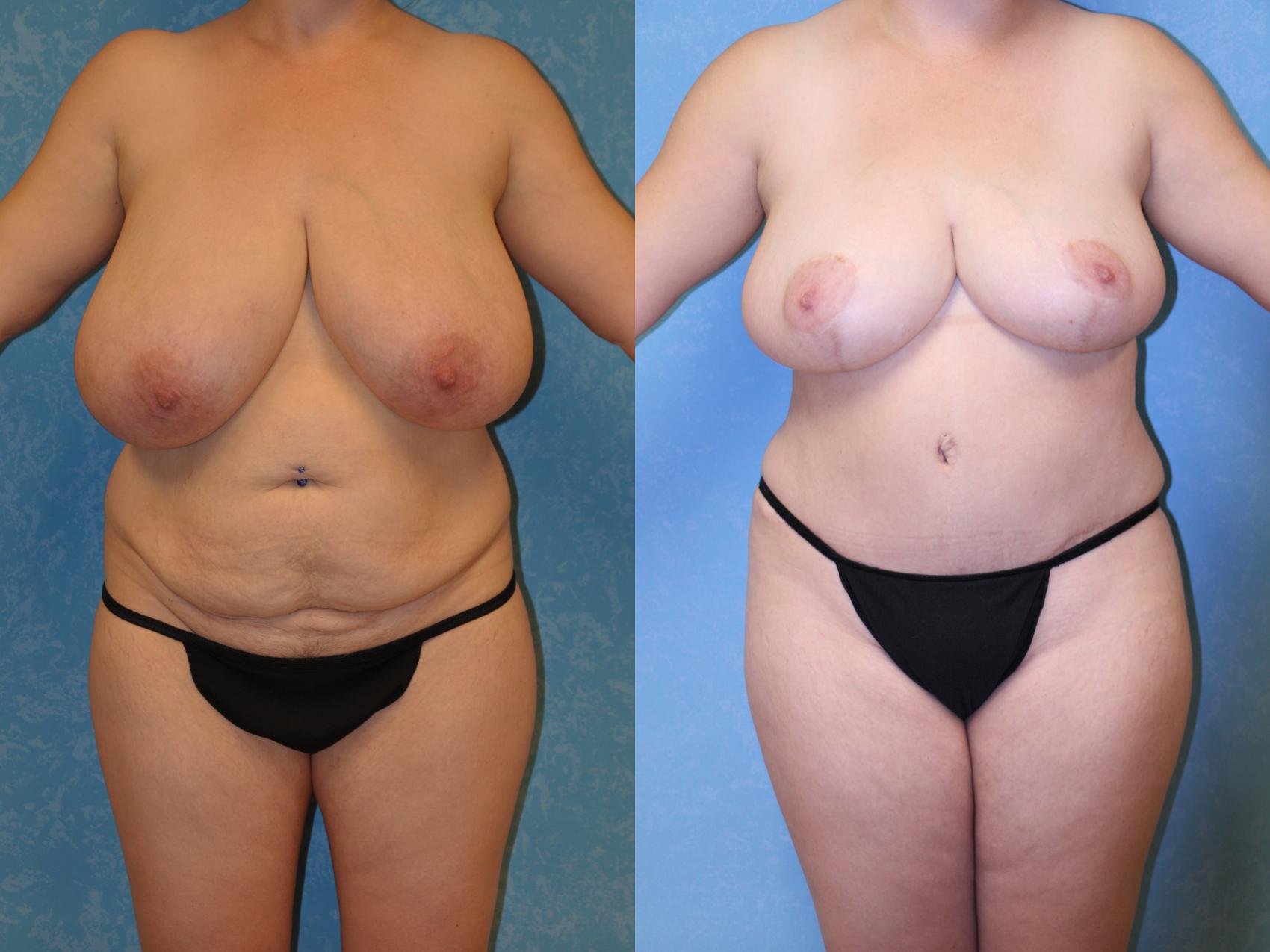Before & After Breast Reduction Case 468 Front View in Toledo, Ohio
