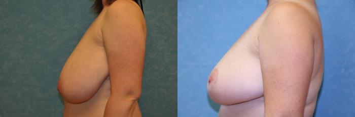 Before & After Breast Reduction Case 468 Left Side View in Toledo, Ohio