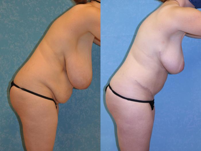 Before & After Mommy Makeover Case 468 Right Bent Forward View in Toledo, Ohio