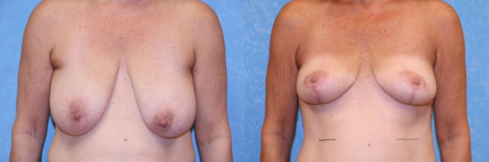 Before & After Breast Reduction Case 488 Front View in Toledo, Ohio