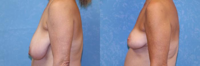 Before & After Breast Reduction Case 488 Left Side View in Toledo, Ohio