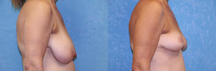 Before & After Breast Reduction Case 488 Right Side View in Toledo, Ohio
