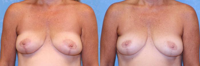 Before & After Breast Reduction Case 488 Scar Progression View in Toledo, Ohio