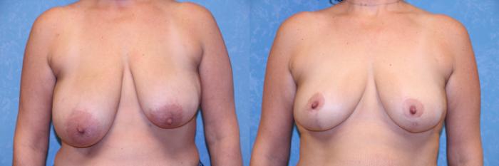 Before & After Breast Reduction Case 489 Front View in Toledo, Ohio