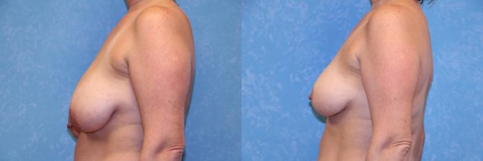 Before & After Breast Reduction Case 489 Left Side View in Toledo, Ohio