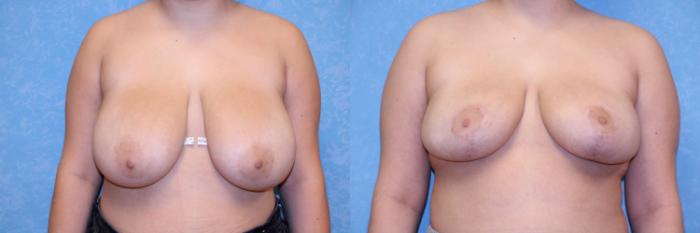 Before & After Breast Reduction Case 491 Front View in Toledo, Ohio