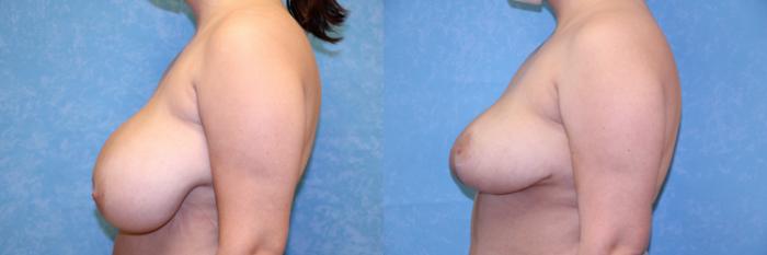 Before & After Breast Reduction Case 491 Left Side View in Toledo, Ohio