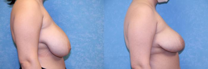 Before & After Breast Reduction Case 491 Right Side View in Toledo, Ohio