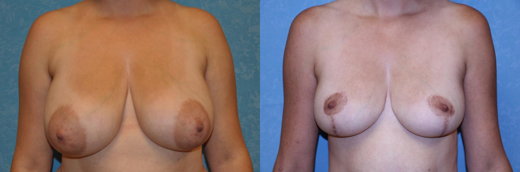 Before & After Breast Reduction Case 494 Front View in Toledo, Ohio