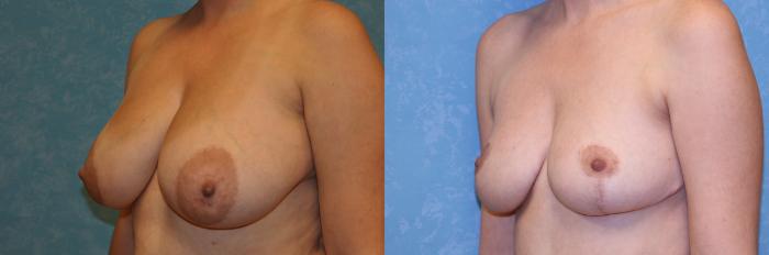 Before & After Breast Reduction Case 494 Left Oblique View in Toledo, Ohio