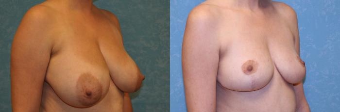Before & After Breast Reduction Case 494 Right Oblique View in Toledo, Ohio
