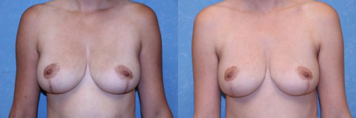 Before & After Breast Reduction Case 494 View 2 View in Toledo, Ohio