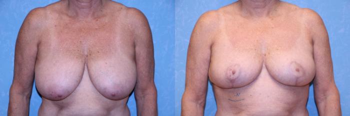 Before & After Breast Reduction Case 506 Front View in Toledo, Ohio