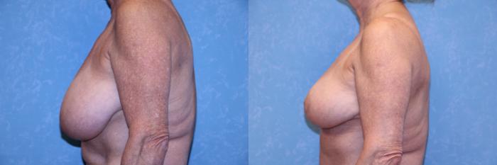 Before & After Breast Reduction Case 506 Left Side View in Toledo, Ohio