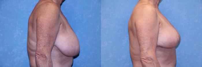 Before & After Breast Reduction Case 506 Right Side View in Toledo, Ohio