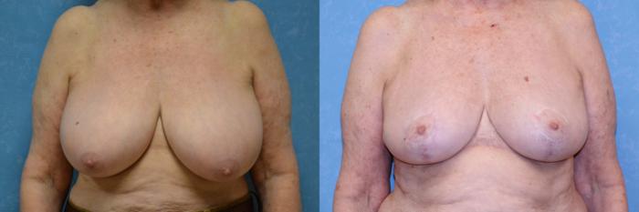 Before & After Breast Reduction Case 520 Front View in Toledo, Ohio