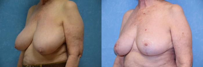 Before & After Breast Reduction Case 520 Left Oblique View in Toledo, Ohio